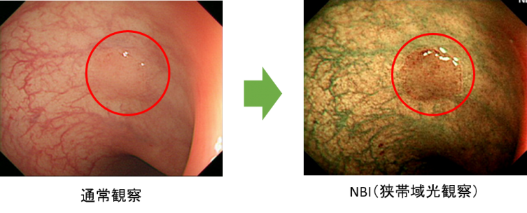 狭帯域光観察(NBI)で微細な病変を発見できます